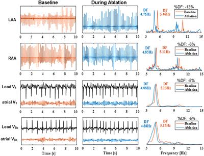 Dynamics of Intraprocedural Dominant Frequency Identifies Ablation Outcome in Persistent Atrial Fibrillation